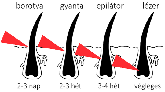 Lézeres szőrtelenítés